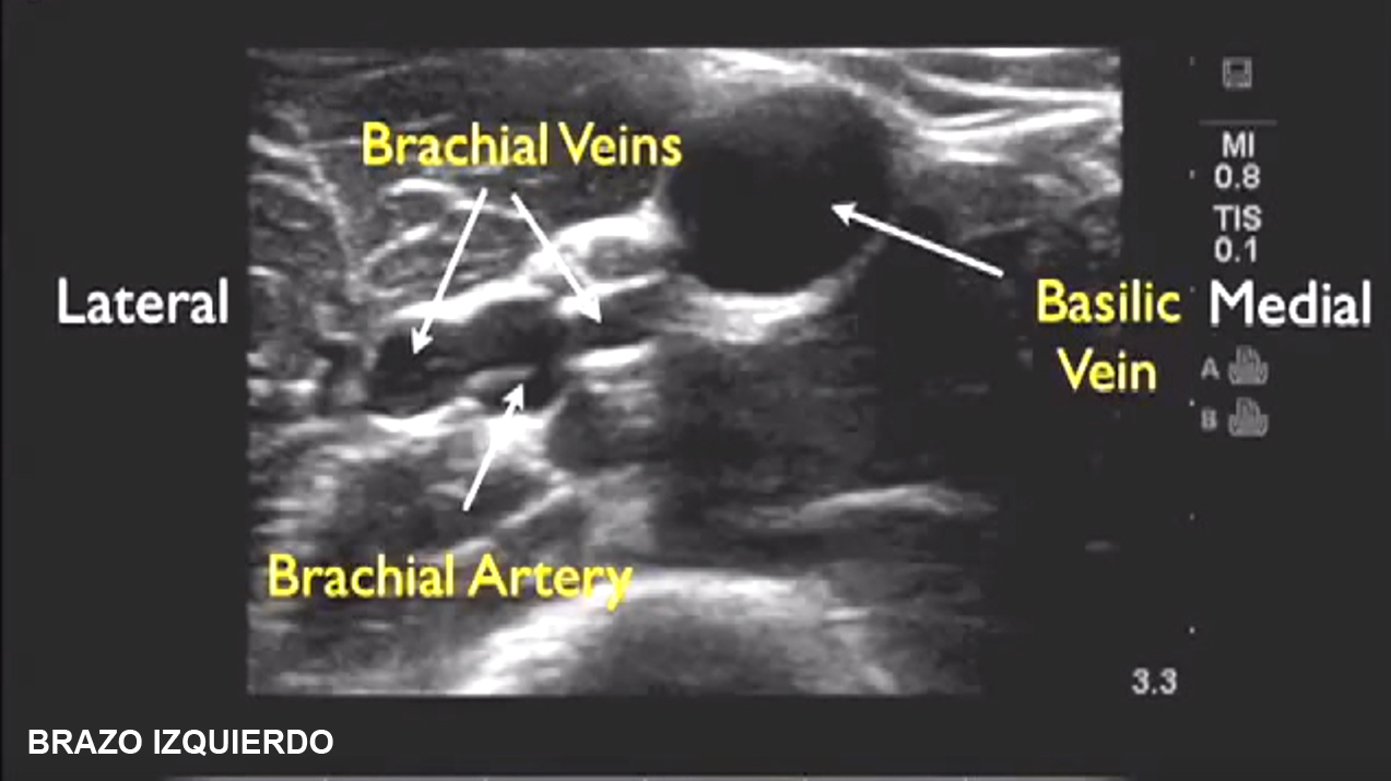 Canalización de vías venosas periféricas guiada por ecografía