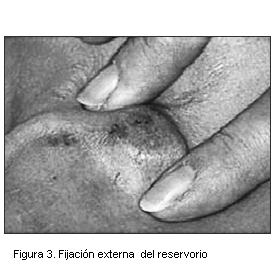 Figura 3. Fijación externa del reservorio
